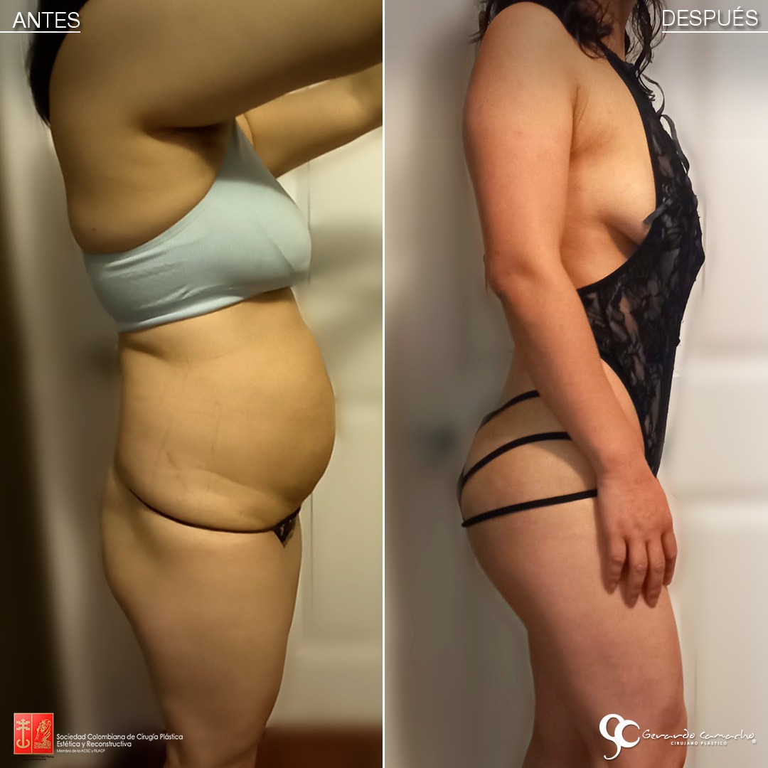 Paciente satisfecha tras abdominoplastia en Bogotá